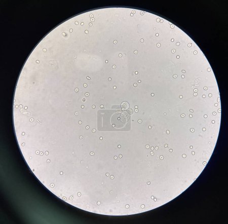Photo for Renal epithelial cell with rbc in Urine examination. - Royalty Free Image