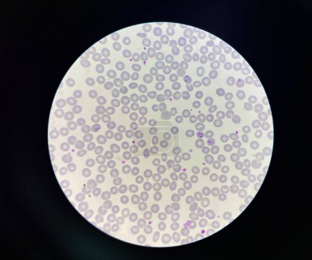 Téléchargez les photos : Malaria pigment blood parasite infected rbc.Thin film. - en image libre de droit