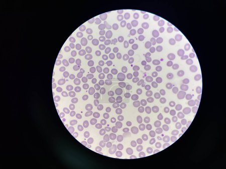 Photo for Abnormal red blood cells morphology macrocyte showing on center blood  smear. - Royalty Free Image