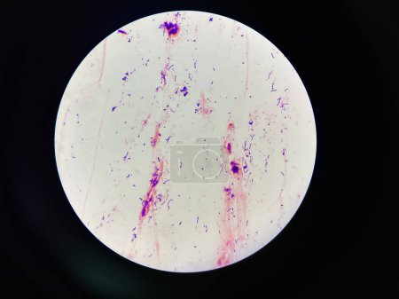 Photo for Mixed organism Bacteria cell in sputum sample Gram stain method. - Royalty Free Image