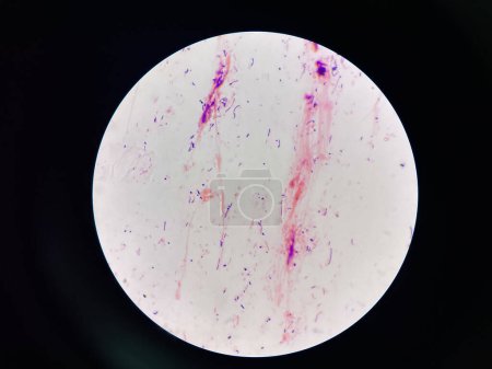 Photo for Mixed organism Bacteria cell in sputum sample Gram stain method. - Royalty Free Image