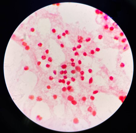 Foto de Neutrofilo moderado en las células inframatorias del líquido sinovial. - Imagen libre de derechos