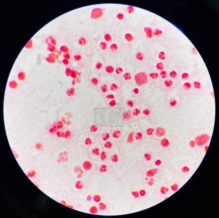 Foto de Neutrofilo moderado en las células inframatorias del líquido sinovial. - Imagen libre de derechos