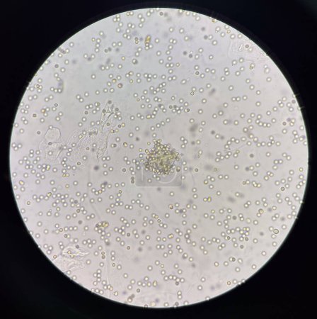 Foto de Cristal de oxalato de calcio en orina fresca con glóbulos rojos moderados . - Imagen libre de derechos