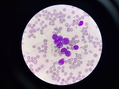 Photo for Immature leukemic cell in leukemia blood smear. - Royalty Free Image