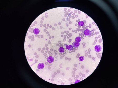 Foto de Células leucémicas inmaduras en la leucemia frotis de sangre. - Imagen libre de derechos
