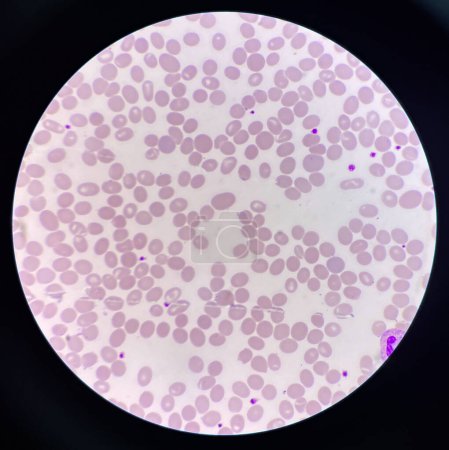 Photo for Blood smear Abnormal cell macro ovalocyte. - Royalty Free Image