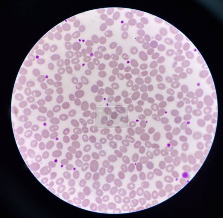 Photo for Blood smear Abnormal cell macro ovalocyte. - Royalty Free Image