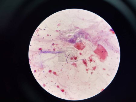 Photo for Gram stain.Gram positive cocci in chain in sputum sample. - Royalty Free Image