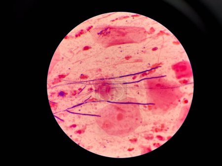 Photo for Mold and budding yeast cell in sputum gram stain. - Royalty Free Image