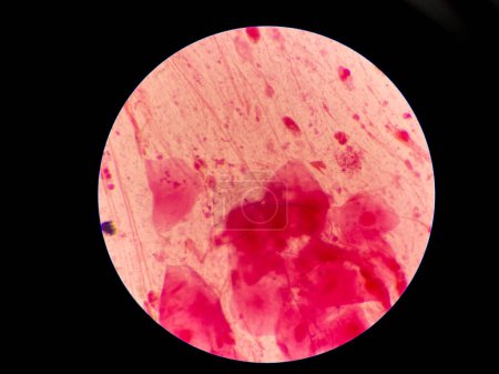 Mold and budding yeast cell in sputum gram stain.
