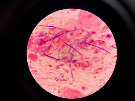 Photo for Mold and budding yeast cell in sputum gram stain. - Royalty Free Image