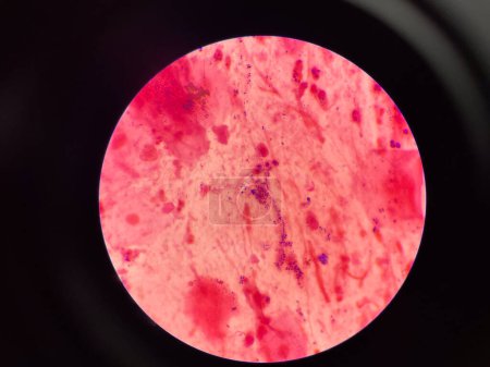 Mold and budding yeast cell in sputum gram stain.