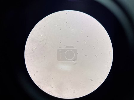 cristal d'oxalate de calcium dans les sédiments urinaires.