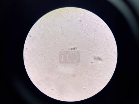 Photo for Calcium oxalate crystal in urine sediment. - Royalty Free Image