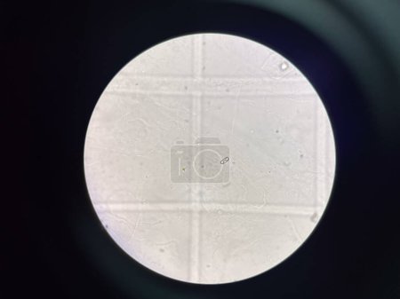 cristal d'oxalate de calcium dans les sédiments urinaires.