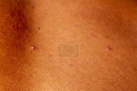 Photo for Human skin texture. wart and pimples on skin micro photo. close up photo. - Royalty Free Image