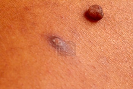 Photo for Human skin texture. wart and pimples on skin micro photo. close up photo. - Royalty Free Image