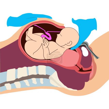 Ilustración de Extirpación del bebé durante el parto mediante cesárea. Movimiento del feto durante la cesárea. Biología y ginecología - Imagen libre de derechos