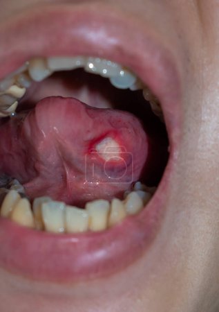 Photo for Ulcer at the tongue of Asian male patient. Diagnosis may be aphthous ulcer, canker sore, stress ulcer or tongue cancer. - Royalty Free Image