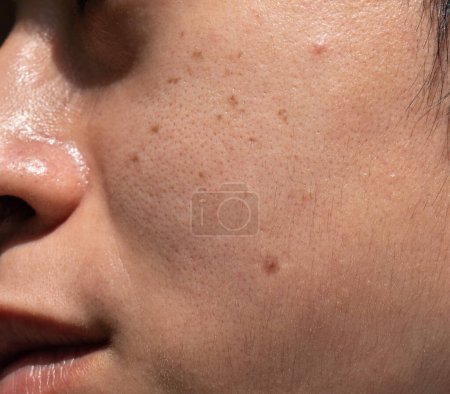 Téléchargez les photos : Taches sombres appelées taches de vieillesse et sur le visage de l'homme asiatique. Ils sont également appelés taches du foie, lentigo sénile, ou taches solaires. Vue rapprochée. - en image libre de droit