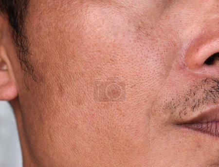 Helle Haut mit weiten Poren im Gesicht eines erwachsenen Mannes aus Südostasien, Myanmar oder Korea.