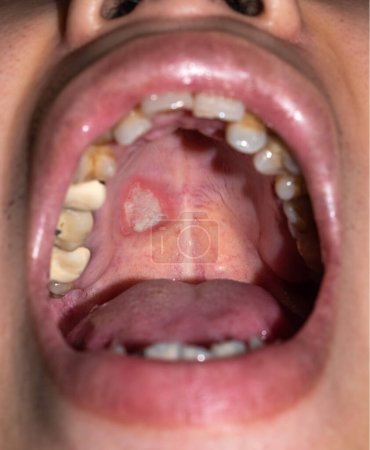 Aphthous ulcer or stress ulcer in mouth of Asian male patient.