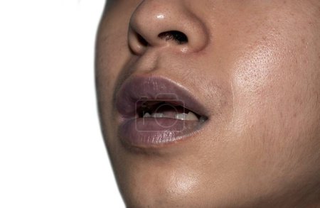 Téléchargez les photos : Cyanose centrale dans les lèvres du jeune homme d'Asie du Sud-Est atteint de cardiopathie congénitale. - en image libre de droit