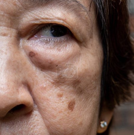 Téléchargez les photos : Petites taches brunes appelées taches d'âge sur le visage de la femme âgée asiatique. Ils sont également appelés taches du foie, lentigo sénile, ou taches solaires. Vue rapprochée. - en image libre de droit