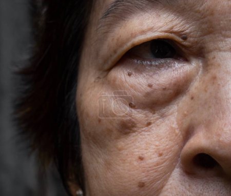 Téléchargez les photos : Petites taches brunes appelées taches d'âge sur le visage de la femme âgée asiatique. Ils sont également appelés taches du foie, lentigo sénile, ou taches solaires. Vue rapprochée. - en image libre de droit