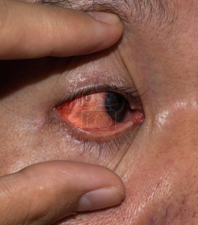 Foto de Corneal infection or ulcer called keratitis in Asian old man. - Imagen libre de derechos
