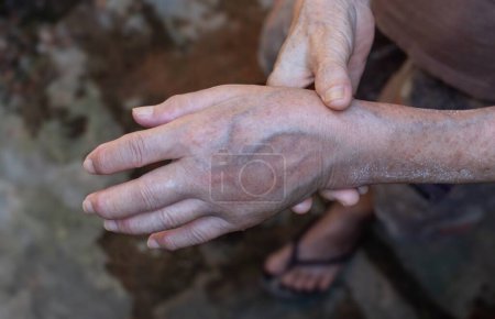 Foto de Unilateral edema of upper limb. Swollen hand and arm of Asian woman. Closeup view. - Imagen libre de derechos