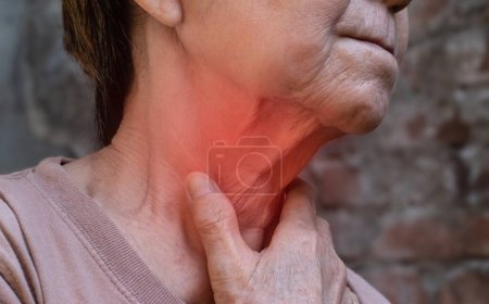 Enrojecimiento en el cuello de una mujer asiática de Myanmar. Concepto de dolor de garganta, faringitis, laringitis, tiroiditis o disfagia.
