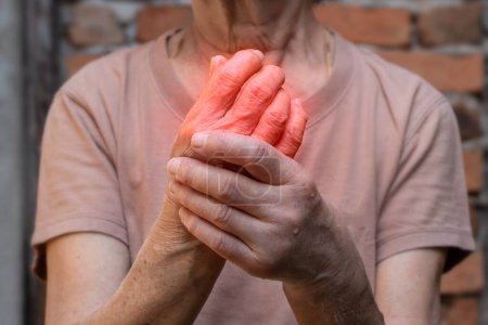 Inflamación de las articulaciones. Concepto e idea de artritis reumática, reumatismo, gota, hinchazón articular o artralgia.