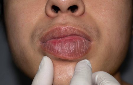Photo for Swollen or thickened lip of Asian young man. Angioedema. Causes may be allergies, infection, injury, etc. - Royalty Free Image