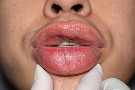 Photo for Swollen or thickened lips of Asian young man. Angioedema. Filler injection complications. Causes may be allergies, infection, injury, etc. - Royalty Free Image