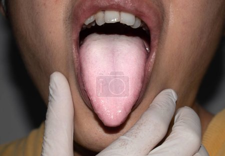 Photo for Coated tongue or white tongue of Asian, Chinese man. It appears with white layer when debris, bacteria and dead cells become lodged between enlarged papillae. Loss of taste called ageusia. - Royalty Free Image
