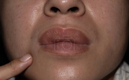 Photo for Swollen or thickened upper lip of Asian young man. Angioedema. Causes may be allergies, infection, injury, etc. - Royalty Free Image