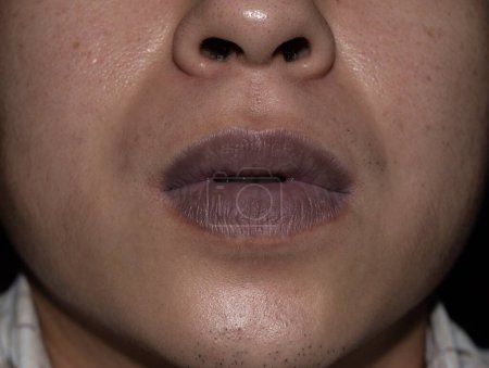 Photo for Central cyanosis in the lips of Southeast Asian young man with congenital heart disease. - Royalty Free Image