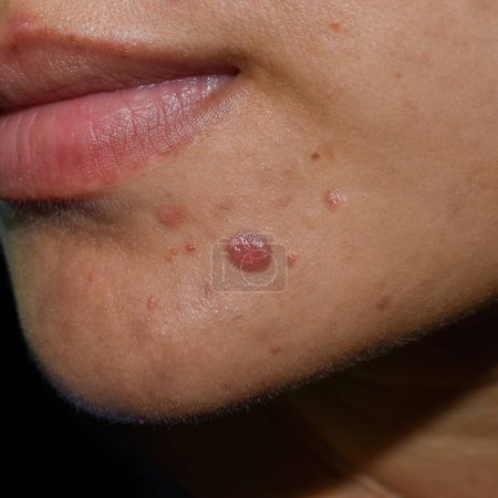Téléchargez les photos : Acné kystique, boutons, taches noires et cicatrices sur le visage huileux de la jeune femme asiatique. - en image libre de droit