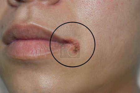 Photo for Angular stomatitis or angular cheilitis or perleche in asian young man. Common inflammatory condition caused by iron, zinc or B12 deficiency, or repetitive trauma. - Royalty Free Image