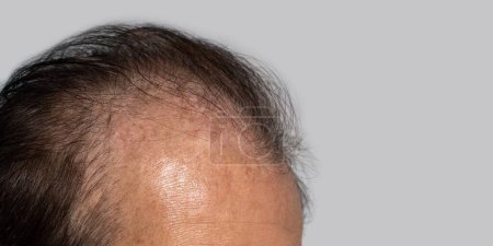 Téléchargez les photos : Tête chauve du vieillard asiatique. Concept de modèle masculin perte de cheveux ou les cheveux clairsemés. - en image libre de droit