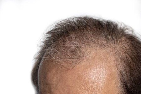 Bald head of Asian elder man. Concept of male pattern hair loss or sparse hair.