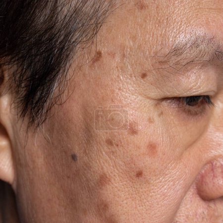Téléchargez les photos : Petites taches brunes appelées taches d'âge sur le visage de l'homme âgé asiatique. Ils sont également appelés taches du foie, lentigo sénile, ou taches solaires. Vue rapprochée. - en image libre de droit