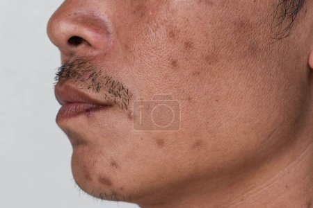 Kleine braune Flecken, sogenannte Altersflecken und Narben im Gesicht des asiatischen Mannes. Leberflecken, seniler Lentigo oder Sonnenflecken.