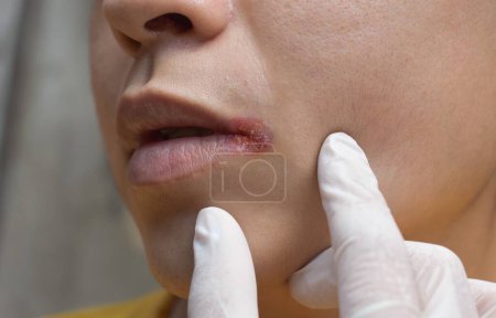 Photo for Angular stomatitis or angular cheilitis or perleche in asian young man. Mouth ulcer. Common inflammatory condition caused by iron, zinc or B12 deficiency, or repetitive trauma. - Royalty Free Image