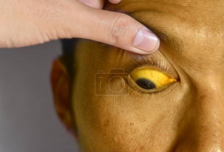 Foto de Ictericia profunda en pacientes varones asiáticos. Decoloración amarillenta de la piel y la esclerótica. Hiperbilirrubinemia. Hepatitis aguda. - Imagen libre de derechos