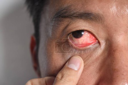 Téléchargez les photos : Infection cornéenne ou ulcère appelé kératite chez l'homme chinois asiatique. - en image libre de droit