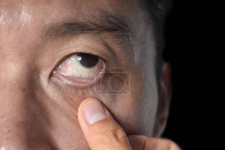 Photo for Pale skin of Asian man. Sign of anemia. Pallor at eyelid. Closeup view. - Royalty Free Image