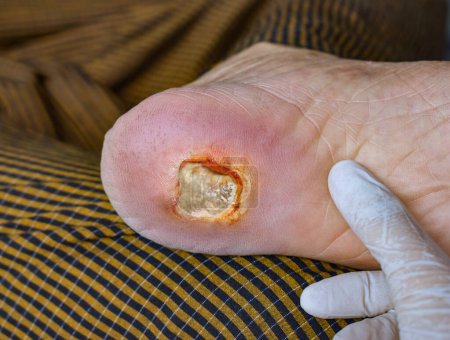 Foto de Úlcera del pie de la diabetes en el pie del paciente masculino asiático. - Imagen libre de derechos